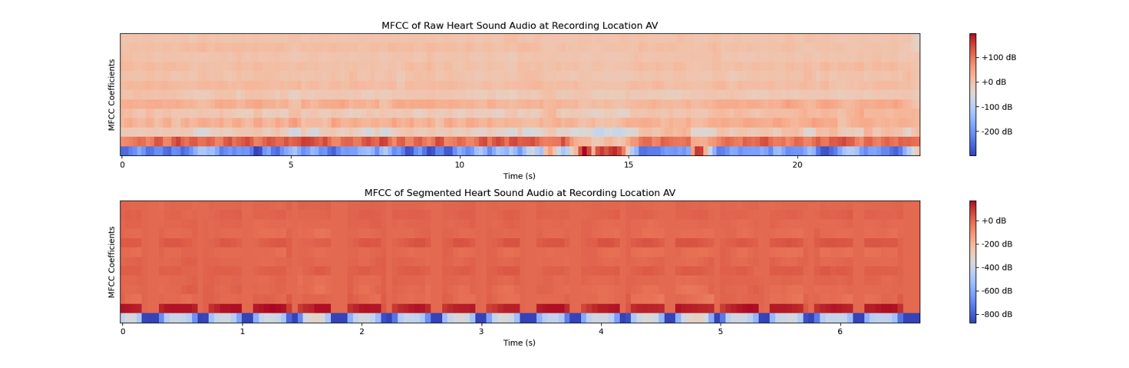 Heart Murmur Detection